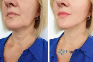 Double chin before and after Hi-Fu treatment 4 Book your double chin treatment High Wycombe today! We are here to help!
