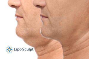 Double chin before and after Hi-Fu treatment 2 Double chin treatment High Wycombe from Lipo Sculpt - feel more confident today!
