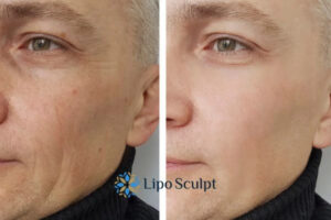 How to Fight Aging Symptoms 3 Fight Aging Symptoms High Wycombe With HIFU and Morpheus8 Today!