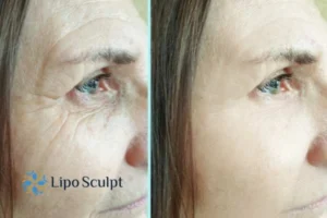 How to Fight Aging Symptoms 2 Do you want to Fight Aging Symptoms High Wycombe? Contact Lipo Sculpt today!