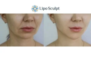 Explaining Total Skin Tightening Treatment And What It Can Do For You 2 Do you want to boost your self confidence? Give Morpheus8 High Wycombe a try today!