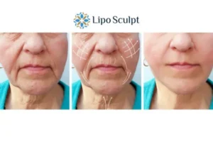 Explaining Total Skin Tightening Treatment And What It Can Do For You 3 Boost your confidence with Morpheus8 High Wycombe call our team today!