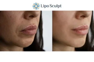 Explaining Total Skin Tightening Treatment And What It Can Do For You 4 Morpheus8 High Wycombe the best results - call our team today!