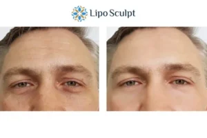 Explaining Total Skin Tightening Treatment And What It Can Do For You 6 Morpheus8 High Wycombe book in today to find out more!