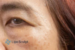 Cryopen: The Revolutionary Treatment for Age Spots Unveiled 2 Are age spots High Wycombe giving you low self esteem? Contact us today!
