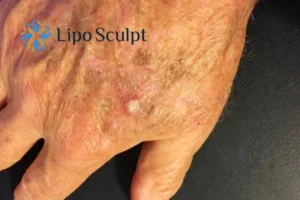 Best Actinic Keratoses Removal 2 Improve your wellbeing and health with Actinic Keratoses High Wycombe removal.treatment