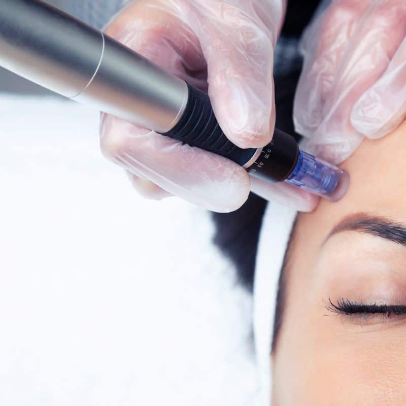 Morpheus8 treatment High Wycombe from Lipo Sculpt - Book in today!