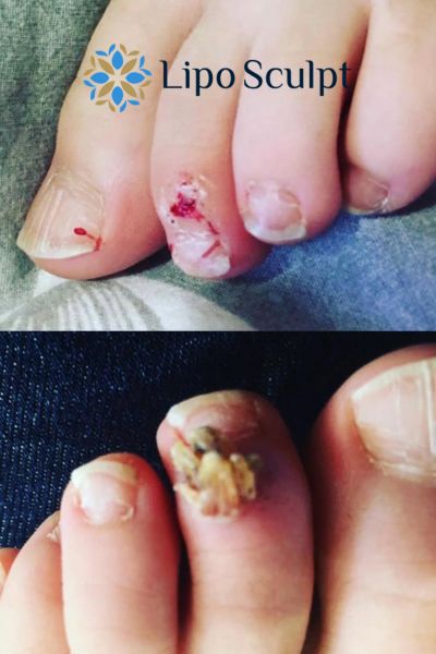 Wart removal customer results from Lipo Sculpt High Wycombe