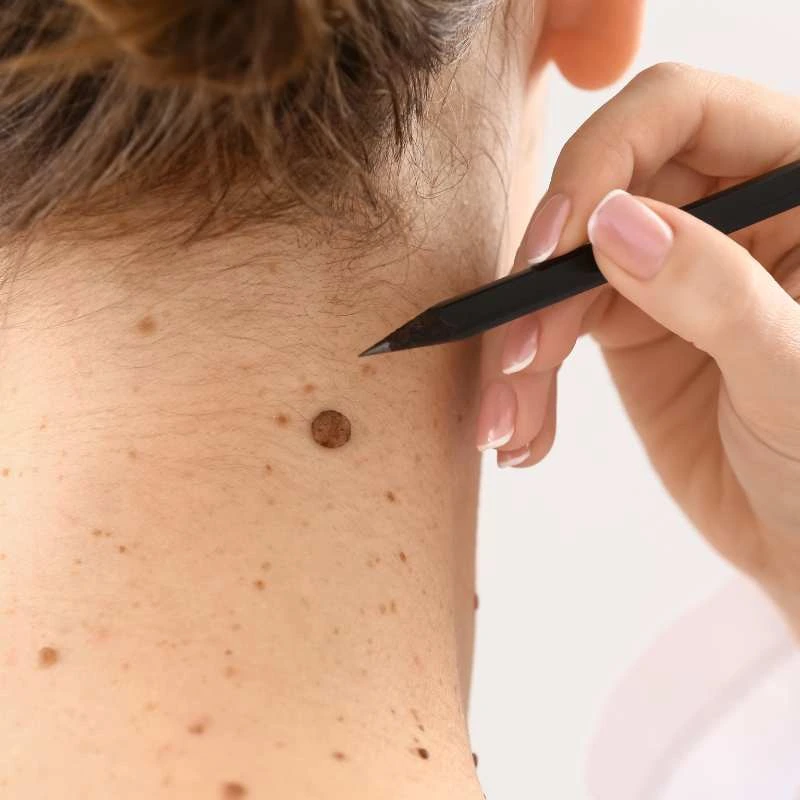 How to Support Your Body During Pregnancy for Faster Postnatal Recovery 5 See our lesion removal prices High Wycombe - call today for a free quote