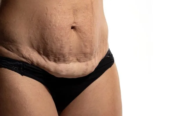 Lost the Weight but Not the Loose Skin? 1 image of womans stomach after weight loss showing loose skin High Wycombe