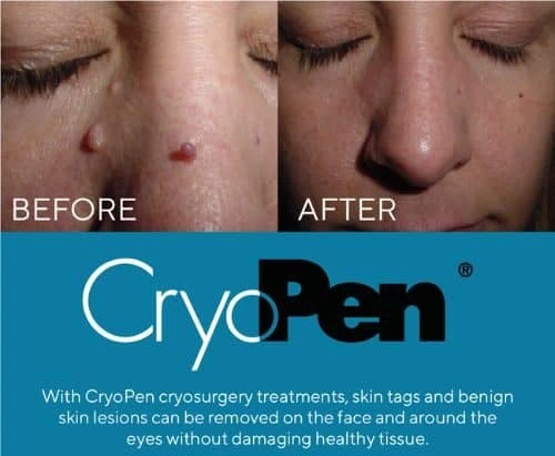 image of angiofibroma removal High Wycombe using Lipo Sculpt cryopen!